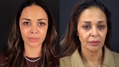 داليا البحيري قبل وبعد عملية التجميل     