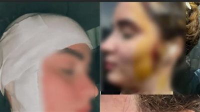 الفتاة المشوهه على يد بلطجي    
